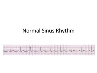 Normal Sinus Rhythm
 