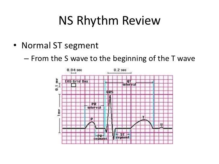 Normal sinus rhythm