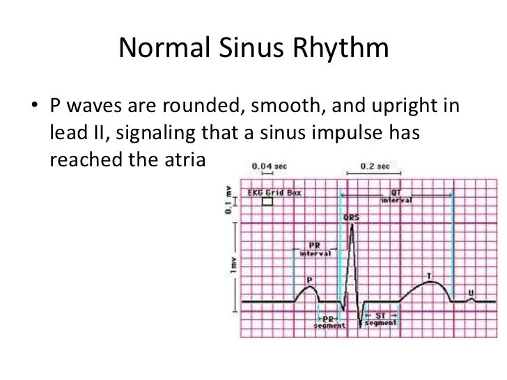 Normal Sinus Rhythm Normal Sinus Rhythm