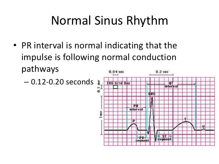 Normal Sinus Rhythm Normal Sinus Rhythm