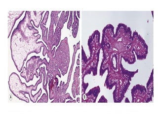 Normal Brea NORMAL STRUCTURE OF BREAST AND BENIGN LESIONS OF (2).pptx