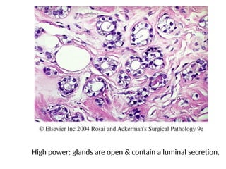 Normal Brea NORMAL STRUCTURE OF BREAST AND BENIGN LESIONS OF (2).pptx