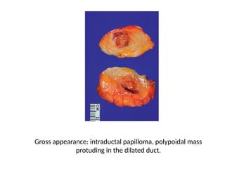 Normal Brea NORMAL STRUCTURE OF BREAST AND BENIGN LESIONS OF (2).pptx