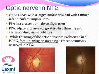 Optic nerve in NTG
 Optic nerves with a larger surface area and with thinner
inferior/inferotemporal rims
 PPA in a crescent or halo configuration
 PPA: adjacent to areas of greatest disc thinning and
corresponding visual field loss
 While thinning of the optic nerve rim is observed in all
POAG, focal thinning or ‘notching’ is more commonly
observed in NTG.
 
