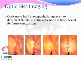 Optic Disc Imaging
 Optic nerve head photography is important to
document the status of the optic nerve at baseline and
for future comparisons
 