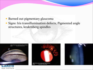  Burned out pigmentary glaucoma
 Signs: Iris transillumination defects, Pigmented angle
structures, krukrnberg spindles
 