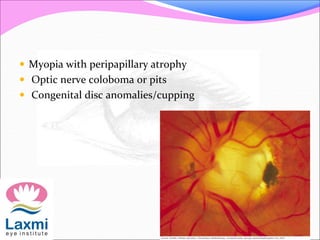  Myopia with peripapillary atrophy
 Optic nerve coloboma or pits
 Congenital disc anomalies/cupping
 