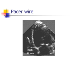 Pacer wire
 