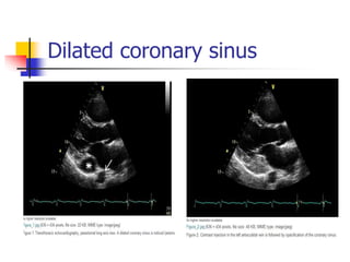 Dilated coronary sinus
 