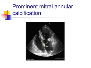 Prominent mitral annular
calcification
 
