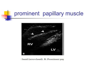 prominent papillary muscle
 