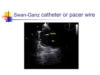 Swan-Ganz catheter or pacer wire
 