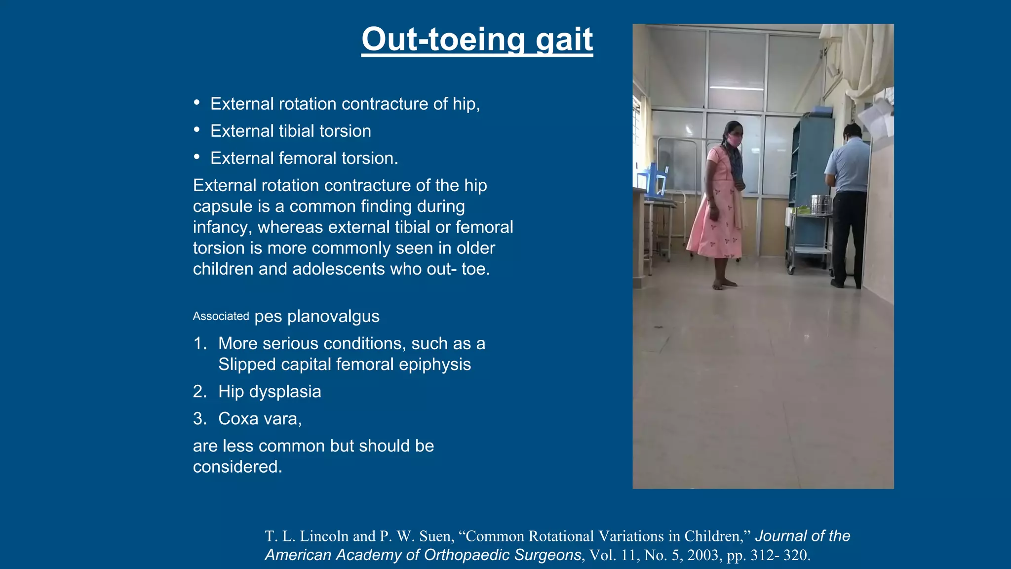 Out-toeing gait
• External rotation contracture of hip,
• External tibial torsion
• External femoral torsion.
External rotation contracture of the hip
capsule is a common finding during
infancy, whereas external tibial or femoral
torsion is more commonly seen in older
children and adolescents who out- toe.
Associated pes planovalgus
1. More serious conditions, such as a
Slipped capital femoral epiphysis
2. Hip dysplasia
3. Coxa vara,
are less common but should be
considered.
T. L. Lincoln and P. W. Suen, “Common Rotational Variations in Children,” Journal of the
American Academy of Orthopaedic Surgeons, Vol. 11, No. 5, 2003, pp. 312- 320.
 