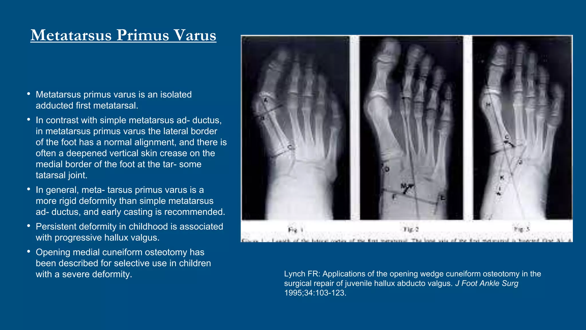 Metatarsus Primus Varus
• Metatarsus primus varus is an isolated
adducted first metatarsal.
• In contrast with simple metatarsus ad- ductus,
in metatarsus primus varus the lateral border
of the foot has a normal alignment, and there is
often a deepened vertical skin crease on the
medial border of the foot at the tar- some
tatarsal joint.
• In general, meta- tarsus primus varus is a
more rigid deformity than simple metatarsus
ad- ductus, and early casting is recommended.
• Persistent deformity in childhood is associated
with progressive hallux valgus.
• Opening medial cuneiform osteotomy has
been described for selective use in children
with a severe deformity. Lynch FR: Applications of the opening wedge cuneiform osteotomy in the
surgical repair of juvenile hallux abducto valgus. J Foot Ankle Surg
1995;34:103-123.
 