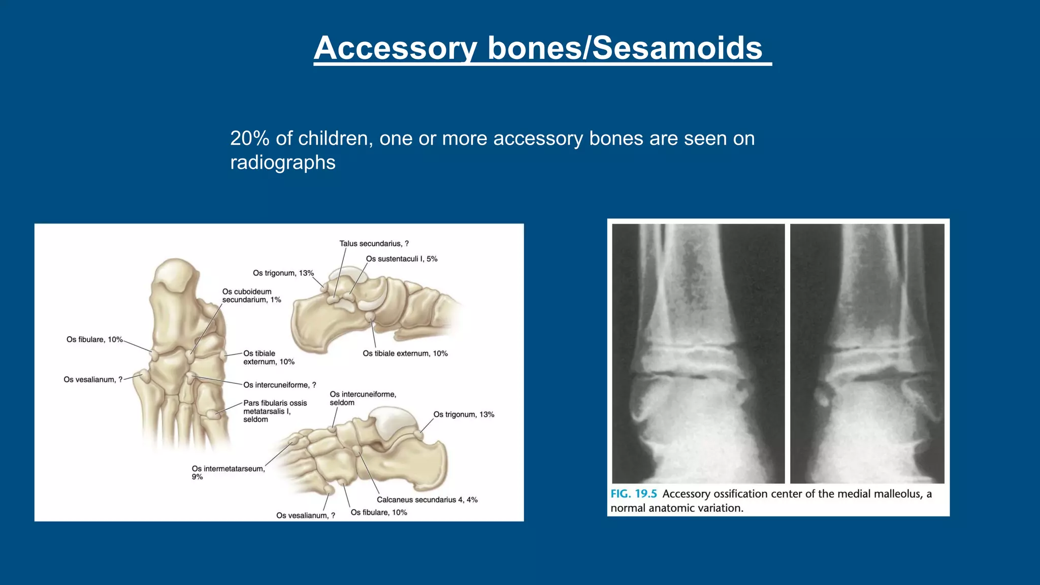 Accessory bones/Sesamoids
20% of children, one or more accessory bones are seen on
radiographs
 