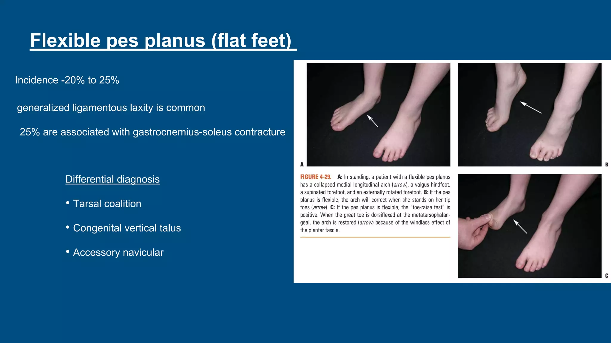 Flexible pes planus (flat feet)
Incidence -20% to 25%
generalized ligamentous laxity is common
25% are associated with gastrocnemius-soleus contracture
Differential diagnosis
• Tarsal coalition
• Congenital vertical talus
• Accessory navicular
 