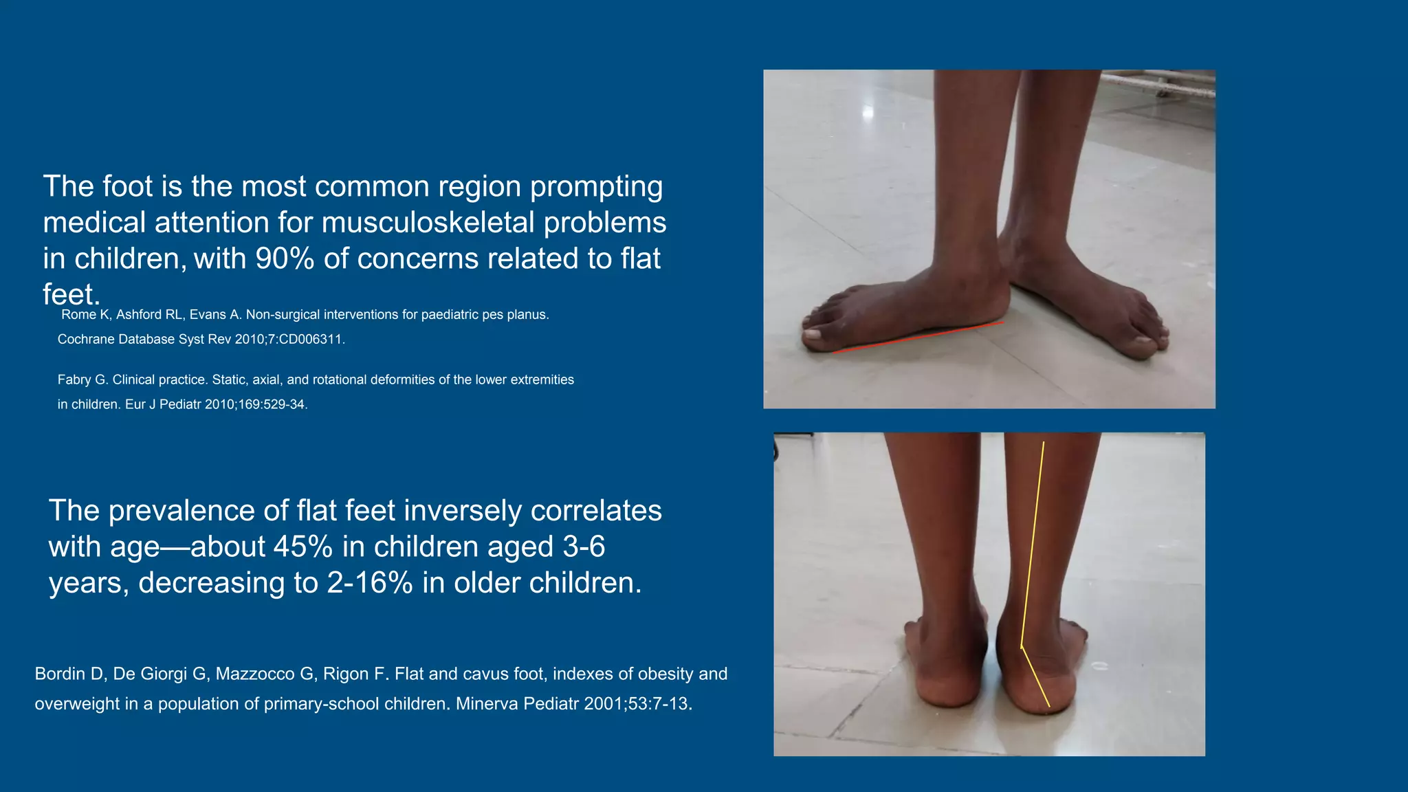The foot is the most common region prompting
medical attention for musculoskeletal problems
in children, with 90% of concerns related to flat
feet.
Rome K, Ashford RL, Evans A. Non-surgical interventions for paediatric pes planus.
Cochrane Database Syst Rev 2010;7:CD006311.
Fabry G. Clinical practice. Static, axial, and rotational deformities of the lower extremities
in children. Eur J Pediatr 2010;169:529-34.
The prevalence of flat feet inversely correlates
with age—about 45% in children aged 3-6
years, decreasing to 2-16% in older children.
Bordin D, De Giorgi G, Mazzocco G, Rigon F. Flat and cavus foot, indexes of obesity and
overweight in a population of primary-school children. Minerva Pediatr 2001;53:7-13.
 