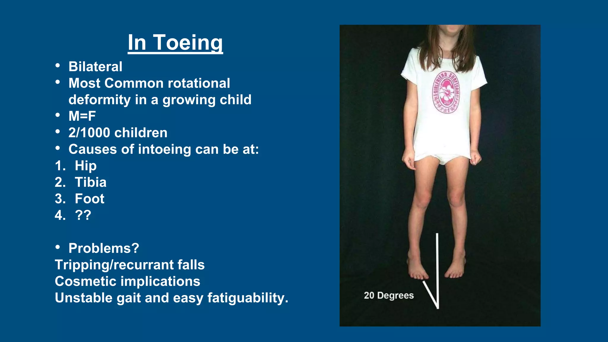 • Bilateral
• Most Common rotational
deformity in a growing child
• M=F
• 2/1000 children
• Causes of intoeing can be at:
1. Hip
2. Tibia
3. Foot
4. ??
• Problems?
Tripping/recurrant falls
Cosmetic implications
Unstable gait and easy fatiguability.
In Toeing
 