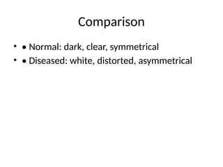 Distorted Vs Normal Radiographic Differences Between Normal and Diseased Lungs: A ...