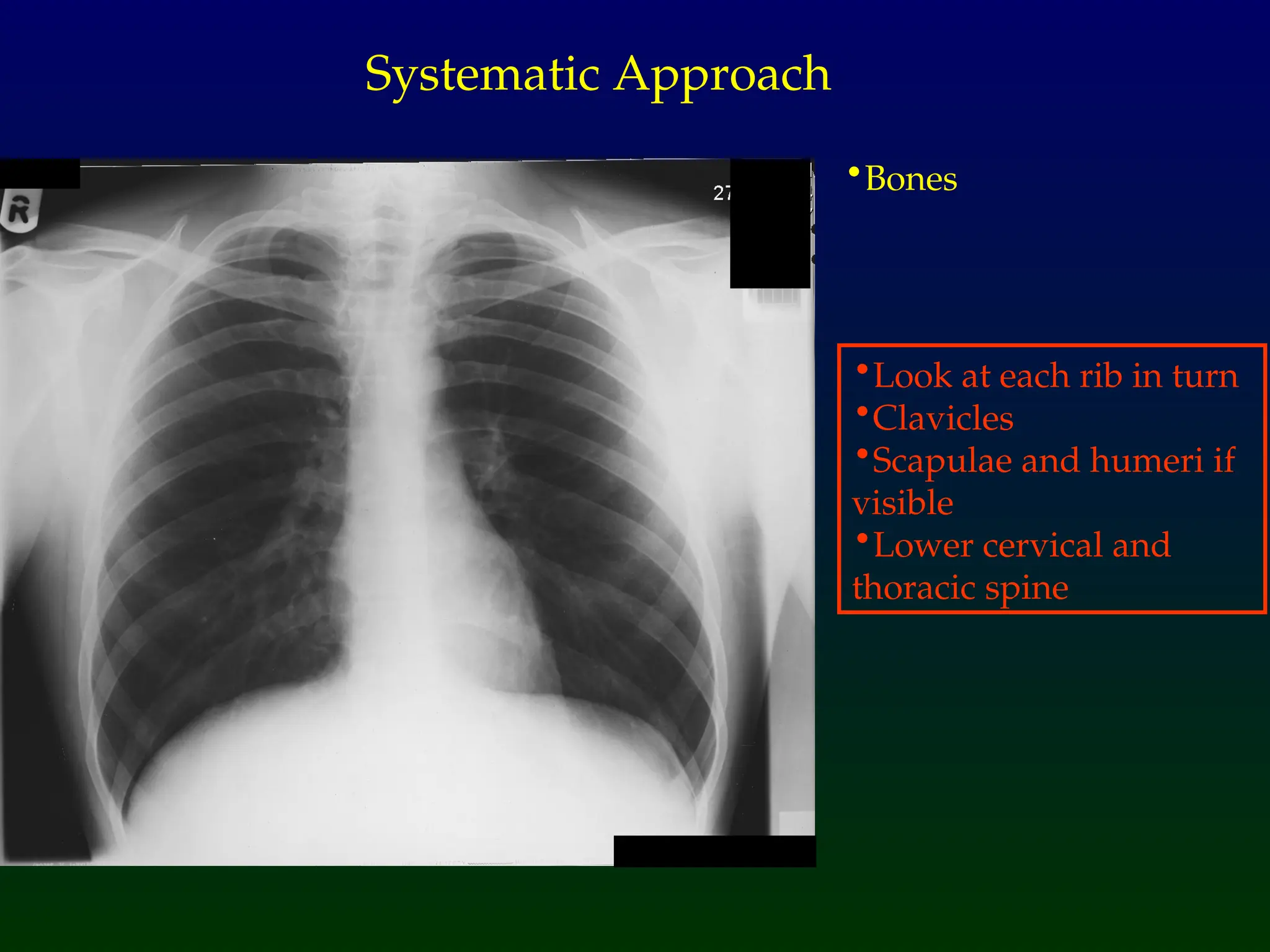 •Bones
Systematic Approach
•Look at each rib in turn
•Clavicles
•Scapulae and humeri if
visible
•Lower cervical and
thoracic spine
 