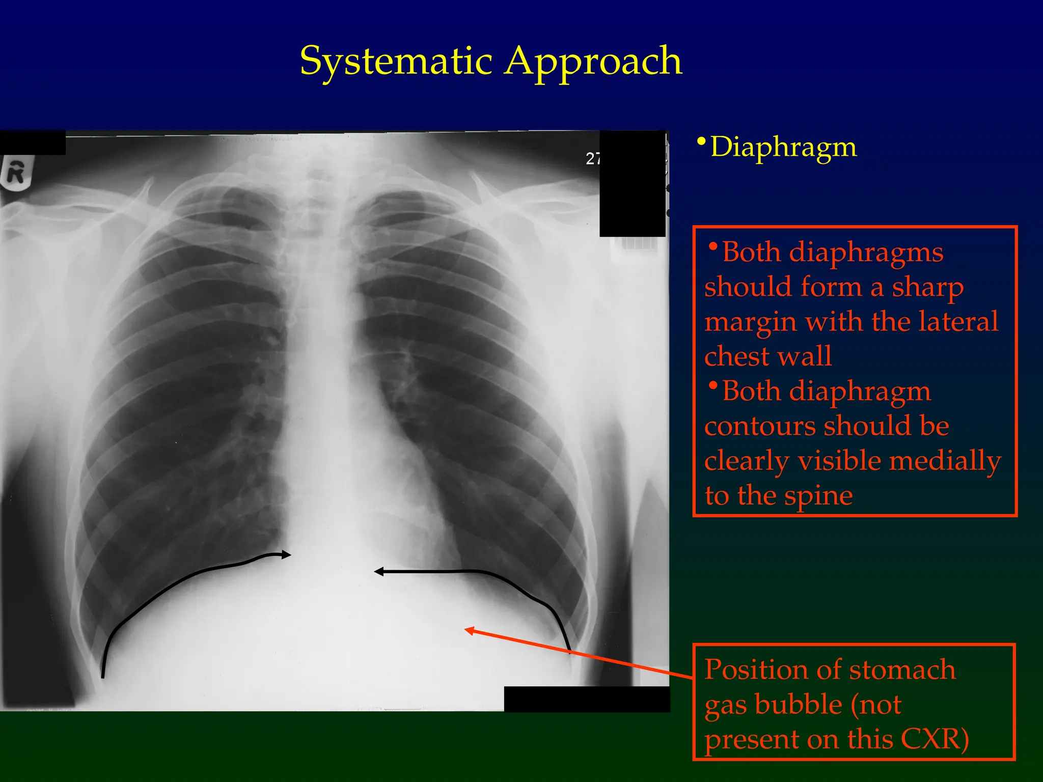 •Diaphragm
Systematic Approach
•Both diaphragms
should form a sharp
margin with the lateral
chest wall
•Both diaphragm
contours should be
clearly visible medially
to the spine
Position of stomach
gas bubble (not
present on this CXR)
 