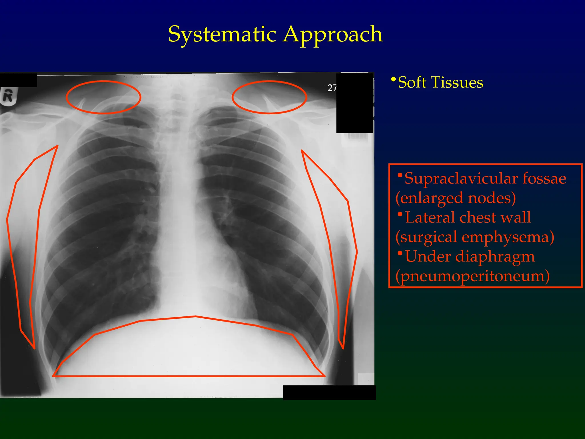 •Soft Tissues
Systematic Approach
•Supraclavicular fossae
(enlarged nodes)
•Lateral chest wall
(surgical emphysema)
•Under diaphragm
(pneumoperitoneum)
 