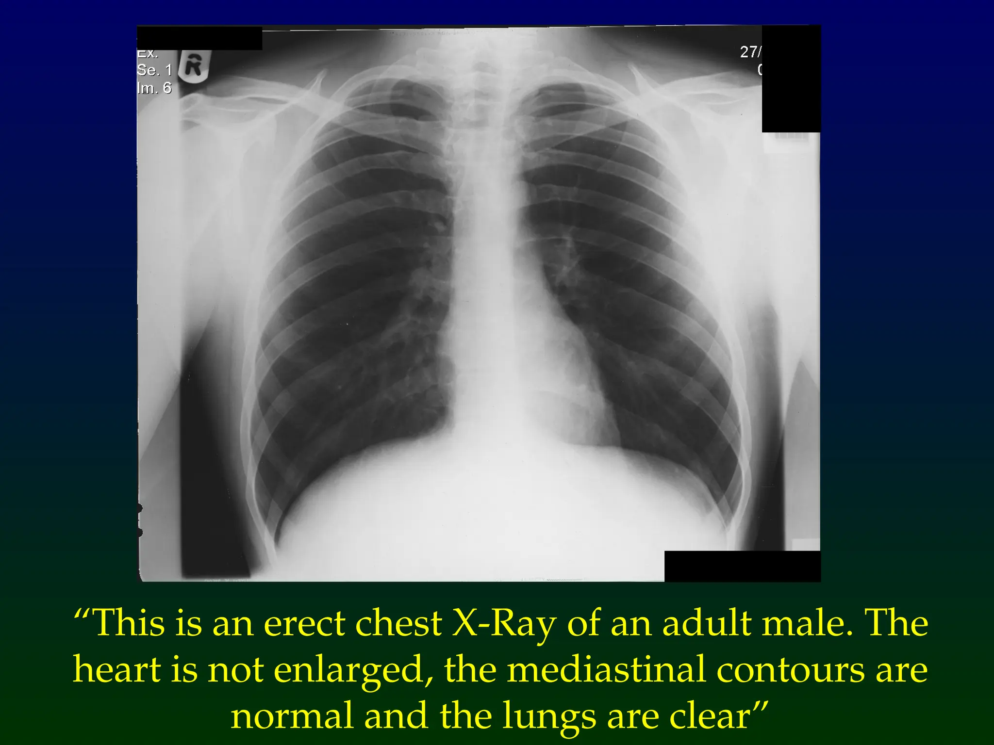 “This is an erect chest X-Ray of an adult male. The
heart is not enlarged, the mediastinal contours are
normal and the lungs are clear”
 