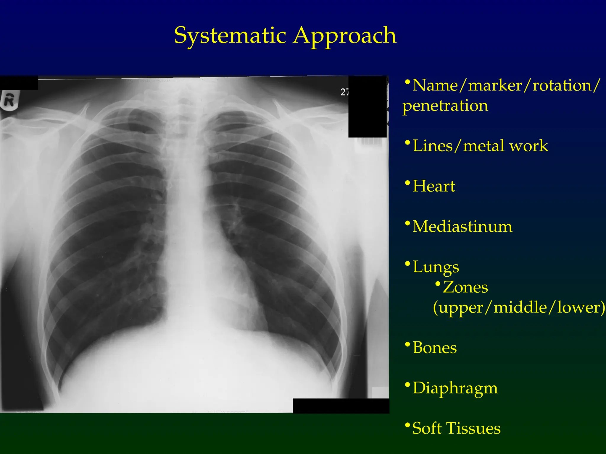 •Name/marker/rotation/
penetration
•Lines/metal work
•Heart
•Mediastinum
•Lungs
•Zones
(upper/middle/lower)
•Bones
•Diaphragm
•Soft Tissues
Systematic Approach
 