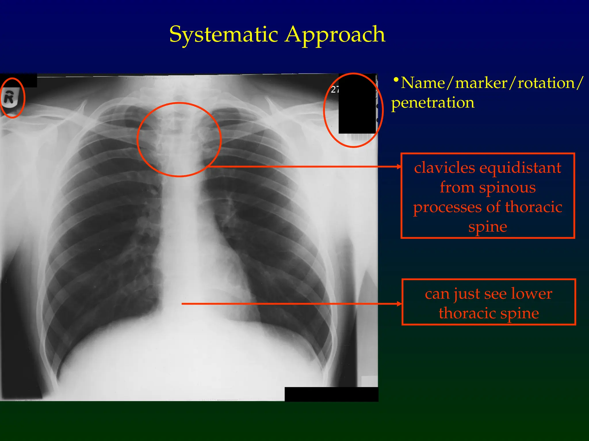 •Name/marker/rotation/
penetration
Systematic Approach
clavicles equidistant
from spinous
processes of thoracic
spine
can just see lower
thoracic spine
 