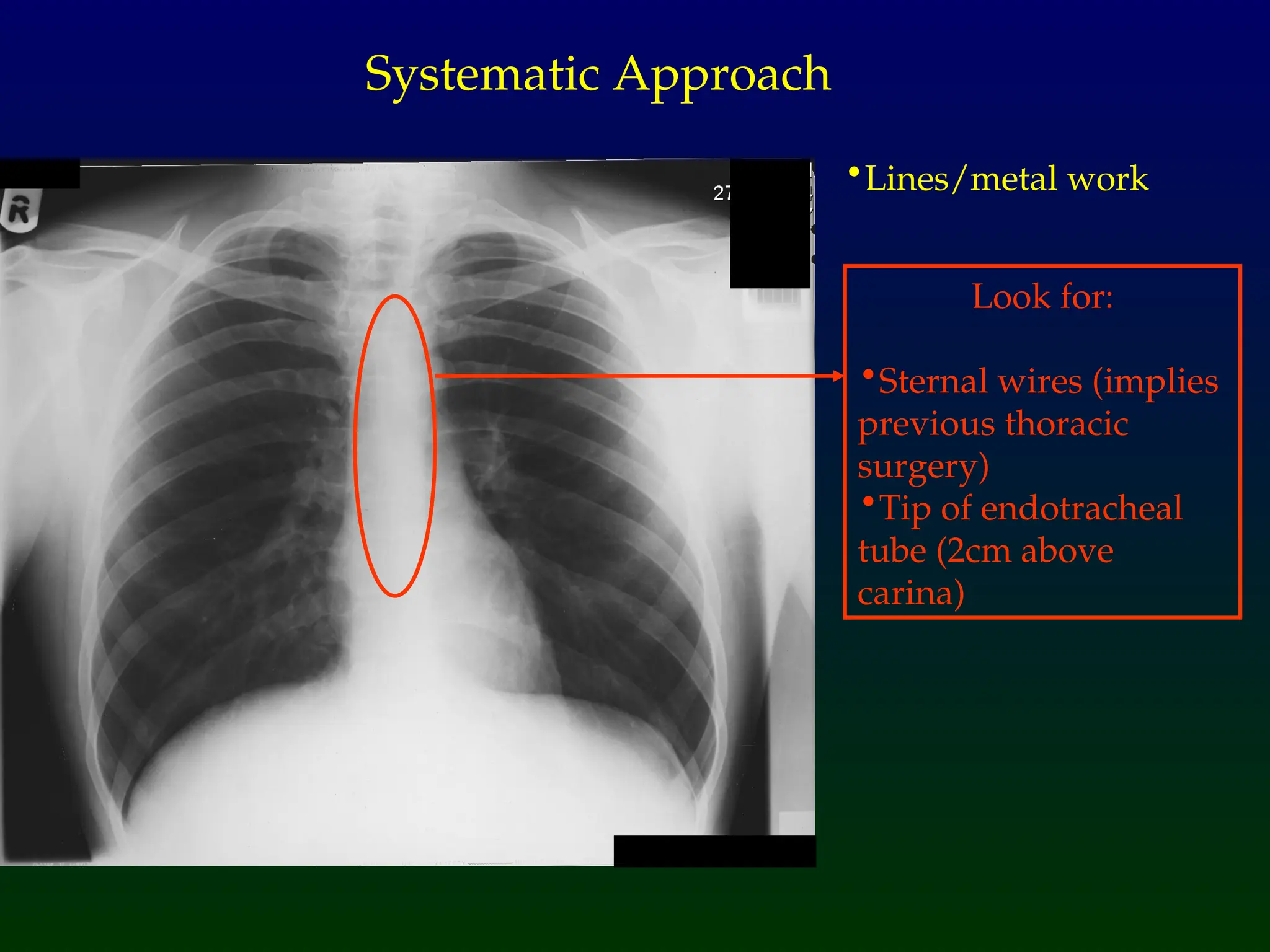 •Lines/metal work
Systematic Approach
Look for:
•Sternal wires (implies
previous thoracic
surgery)
•Tip of endotracheal
tube (2cm above
carina)
 