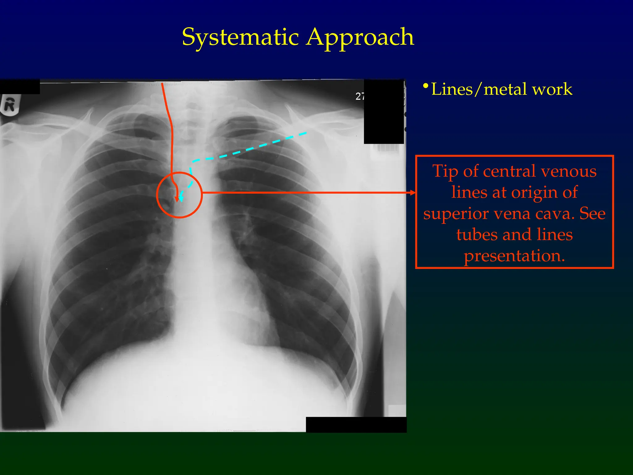 •Lines/metal work
Systematic Approach
Tip of central venous
lines at origin of
superior vena cava. See
tubes and lines
presentation.
 