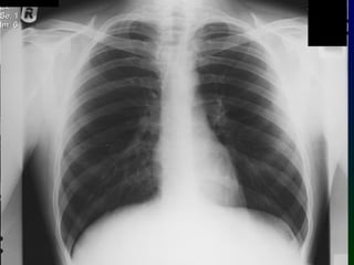normal chest radiohgraphy interpretation .ppt