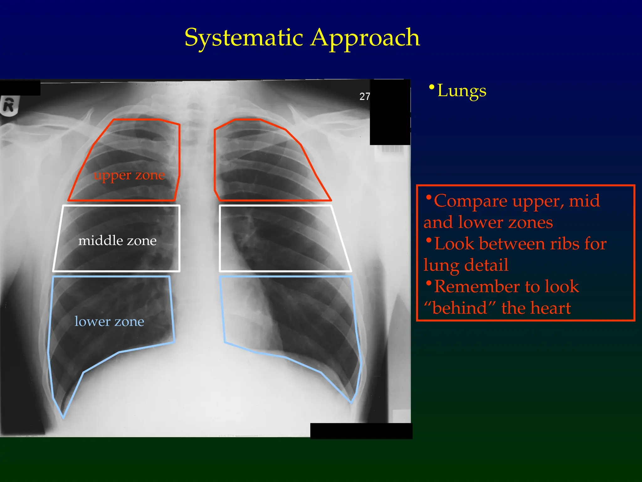 •Lungs
Systematic Approach
upper zone
lower zone
middle zone
•Compare upper, mid
and lower zones
•Look between ribs for
lung detail
•Remember to look
“behind” the heart
 