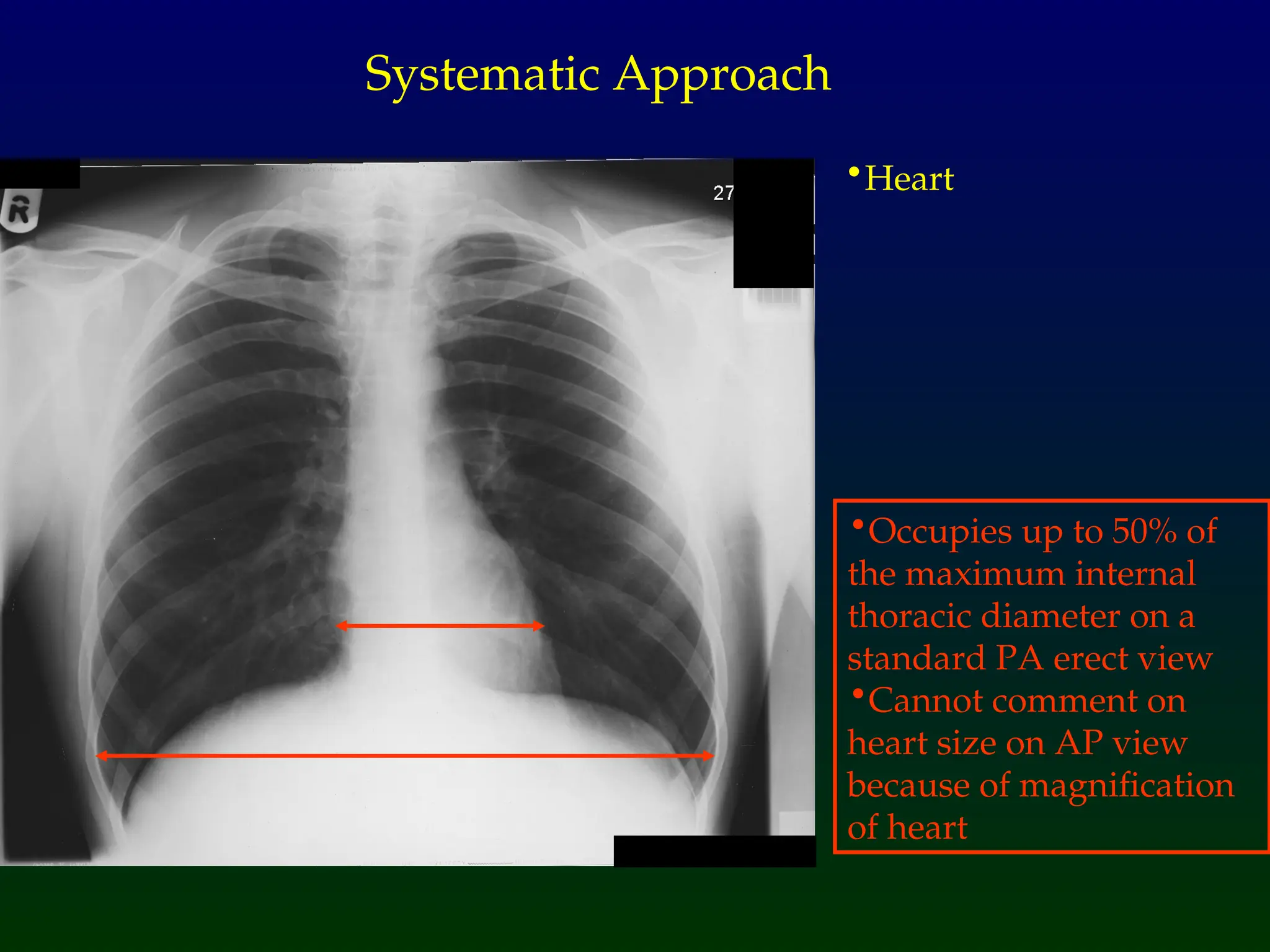 •Heart
Systematic Approach
•Occupies up to 50% of
the maximum internal
thoracic diameter on a
standard PA erect view
•Cannot comment on
heart size on AP view
because of magnification
of heart
 