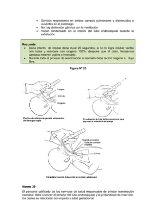 • Sonidos respiratorios en ambos campos pulmonares y disminuidos o
ausentes en el estomago.
• No hay distensión gástrica con la ventilación
• Vapor condensado en el interior del tubo endotraqueal durante la
exhalación.
Recuerde:
• Cada intento de intubar debe durar 20 segundos, si no lo logra intubar ventile
con bolsa y mascara con oxigeno 100%, después que el color, frecuencia
cardiaca mejoren vuelva a intentarlo.
• Durante todo el proceso de reanimación el neonato debe recibir oxigeno a flujo
libre.
Figura Nº 20
Norma 35
El personal calificado de los servicios de salud responsable de brindar reanimación
neonatal debe conocer el tamaño del tubo endotraqueal y la profundidad de inserción,
los cuales se relacionan con el peso y edad gestacional.
 