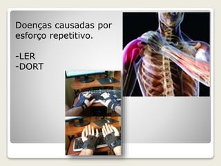 Doenças causadas por 
esforço repetitivo. 
-LER 
-DORT 
 
