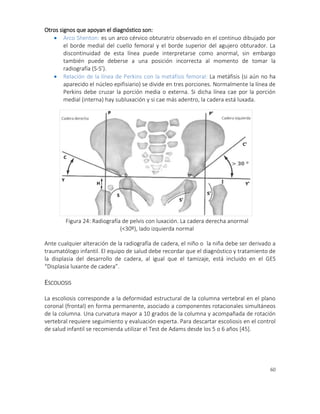 60
1. Displasia de cadera
Otros signos que apoyan el diagnóstico son:
 Arco Shenton: es un arco cérvico obturatriz observado en el continuo dibujado por
el borde medial del cuello femoral y el borde superior del agujero obturador. La
discontinuidad de esta línea puede interpretarse como anormal, sin embargo
también puede deberse a una posición incorrecta al momento de tomar la
radiografía (S-S’).
 Relación de la línea de Perkins con la metáfisis femoral: La metáfisis (si aún no ha
aparecido el núcleo epifisiario) se divide en tres porciones. Normalmente la línea de
Perkins debe cruzar la porción media o externa. Si dicha línea cae por la porción
medial (interna) hay subluxación y si cae más adentro, la cadera está luxada.
Ante cualquier alteración de la radiografía de cadera, el niño o la niña debe ser derivado a
traumatólogo infantil. El equipo de salud debe recordar que el diagnóstico y tratamiento de
la displasia del desarrollo de cadera, al igual que el tamizaje, está incluido en el GES
“Displasia luxante de cadera”.
ESCOLIOSIS
La escoliosis corresponde a la deformidad estructural de la columna vertebral en el plano
coronal (frontal) en forma permanente, asociado a componentes rotacionales simultáneos
de la columna. Una curvatura mayor a 10 grados de la columna y acompañada de rotación
vertebral requiere seguimiento y evaluación experta. Para descartar escoliosis en el control
de salud infantil se recomienda utilizar el Test de Adams desde los 5 o 6 años [45].
Figura 24: Radiografía de pelvis con luxación. La cadera derecha anormal
(<30º), lado izquierda normal
 