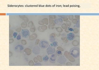 Siderocytes: clustered blue dots of iron; lead poising,
 