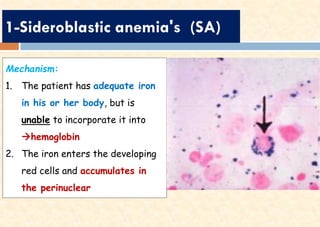 1-Sideroblastic anemia's (SA)
Mechanism:
1. The patient has adequate iron
in his or her body, but is
unable to incorporate it into
→hemoglobin
2. The iron enters the developing
red cells and accumulates in
the perinuclear
 