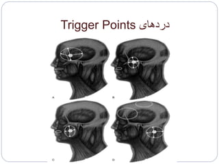 ‫دردهای‬Trigger Points
 