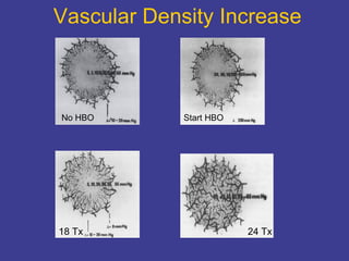 Vascular Density Increase No HBO Start HBO 18 Tx 24 Tx 