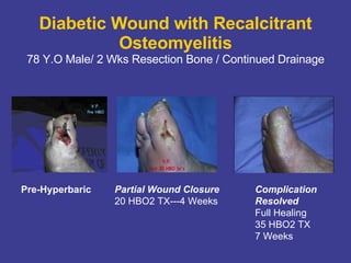 Diabetic Wound with Recalcitrant Osteomyelitis 78 Y.O Male/ 2 Wks Resection Bone / Continued Drainage Pre-Hyperbaric Partial Wound Closure 20 HBO2 TX---4 Weeks Complication Resolved Full Healing 35 HBO2 TX 7 Weeks 
