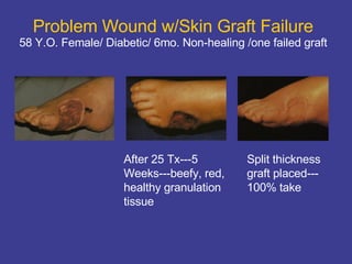 Problem Wound w/Skin Graft Failure 58 Y.O. Female/ Diabetic/ 6mo. Non-healing /one failed graft u After 25 Tx---5  Weeks---beefy, red,  healthy granulation  tissue Split thickness  graft placed--- 100% take 