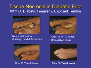 Tissue Necrosis in Diabetic Foot 69 Y.O. Diabetic Female/ w Exposed Tendon After 15 Tx—2 Week  Granulation tissue Required incision,  drainage, and debridement  After 20 Tx---3 Week After 30 Tx---4 Week 