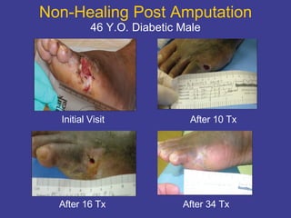 Non-Healing Post Amputation 46 Y.O. Diabetic Male Initial Visit After 10 Tx After 16 Tx After 34 Tx 