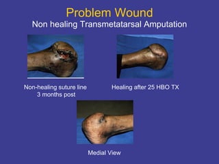 Problem Wound Non healing Transmetatarsal Amputation Non-healing suture line  3 months post Healing after 25 HBO TX Medial View 