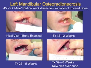 Left Mandibular Osteoradionecrosis 45 Y.O. Male/ Radical neck dissection/ radiation/ Exposed Bone Initial Visit—Bone Exposed Tx 12—2 Weeks Tx 25---5 Weeks Tx 39---8 Weeks New skin over bone 