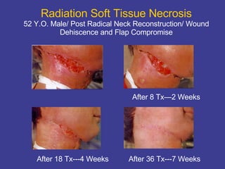 Radiation Soft Tissue Necrosis 52 Y.O. Male/ Post Radical Neck Reconstruction/ Wound Dehiscence and Flap Compromise After 8 Tx—2 Weeks After 36 Tx---7 Weeks After 18 Tx---4 Weeks 