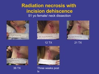Radiation necrosis with  incision dehiscence 51 yo female/ neck dissection 12 TX 21 TX 36 TX Three weeks post tx 