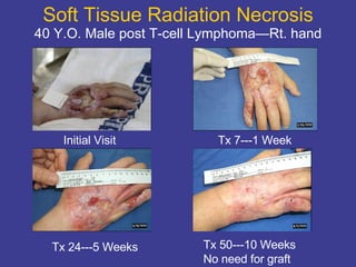 Soft Tissue Radiation Necrosis 40 Y.O. Male post T-cell Lymphoma—Rt. hand Initial Visit Tx 7---1 Week Tx 24---5 Weeks Tx 50---10 Weeks No need for graft 